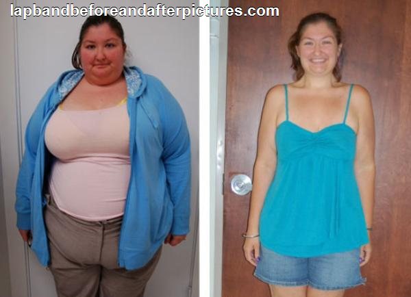 Вес после бариатрической операции. Операция по уменьшению веса. Похудение после бариатрии. Резекция желудка для похудения до и после.